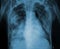 X-ray picture of a patient with lung disease