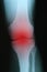 X ray with red inflammation of knee joint closeup