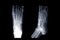 X-ray Right foot image  AP , oblique and lateral