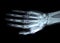 X-ray right hand