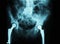 x-ray/ rtg of human pelvis - hip joint replacemen