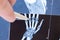 X-ray scan of hand, bones and finger joints. Doctor pointed on finger small joints, where pathology is detected, such as arthritis