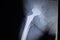 X-ray scan image of hip joint replacement orthopedic implant