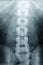 X-ray Scoliosis film x-ray lumbar spine AP