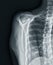 X-ray Shoulder joint shoulder front view for diagnosis fracture of shoulder joint
