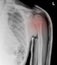 X-ray shoulder showed closed fracture left humerus