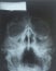 X-ray of the sinuses of the nose