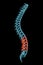 X-ray spinal column with lordosis posture and pathological vertebrae highlighted in red. Human curvature of the spine disorder 3D