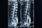 X-ray spine radiography