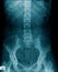 X-ray thoraco-lumbar human structure with pelvic bone