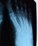 X-ray of toes. Foot on Xray. bone