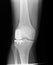 X ray of a unilateral knee replacement