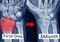 X-ray wrist show fracture distal radius forearm`s bone
