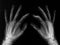 X-rayed hands