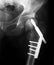 X-Rayed hip