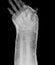 X-rayed human left hand. X-ray of hand bones