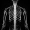 x-rays of the spine, Scoliosis film x-ray show spinal bend in teenager patient