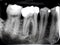 Xray dental film amalgam filling