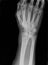 Xray of epiphysial radial fracture reduced with permanent synthetic means