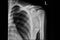 Xray film of a patient with fractured left clavicle