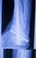 Xray foot heel ankle scan