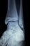 Xray foot heel ankle scan