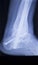 Xray foot heel ankle scan