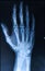 Xray of Hand/ fingers