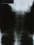 Xray Human Neck