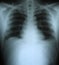 Xray of a human thorax