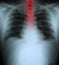 Xray of a human thorax with esophagus highlighted