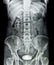 Xray image of human torso blur and noise