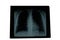 Xray lungs radiological image of patient lung parenchyma homogeneous radiographic pattern and aortic button prominence