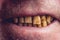 Yellow and curved teeth of a smoker covered with dental stone