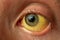 Yellow staining of the sclera of the eye in diseases of the liver, cirrhosis, hepatitis