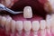 Yellow Teeth veneers treatment whitening. Happy smiling person. Generation AI