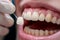 Yellow Teeth veneers treatment whitening. Happy smiling person. Generation AI