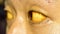 Yellowish discoloration of skin and sclera or deep jaundice in face of Southeast Asian young man.