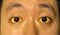 Yellowish discoloration of skin and sclera or deep jaundice in face of Southeast Asian young man.
