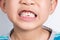 Young Asian boy showing two missing frontal teeth