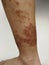 Young boy has Chronic rash on skin. Grass allergic skin disease. Atopic dermatitis.