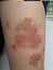 Young boy has Chronic rash on skin. Grass allergic skin disease. Atopic dermatitis.