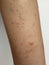 Young boy has Chronic rash on skin. Grass allergic skin disease. Atopic dermatitis. Age spot skin