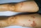 Young boy has Chronic rash on skin. Grass allergic skin disease. Atopic dermatitis. Age spot skin