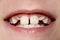 Young Boy\'s Teeth Closeup