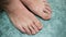 Young man barefoot fingers with sick onycho mycosis nails,dermatologic illness