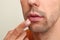 Young man with cold sore applying cream on lips against light background