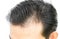 Young man serious hair loss problem for hair loss concept