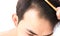 Young man serious hair loss problem for health care shampoo and