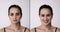 Before After Young Woman Aesthetic Facelift.